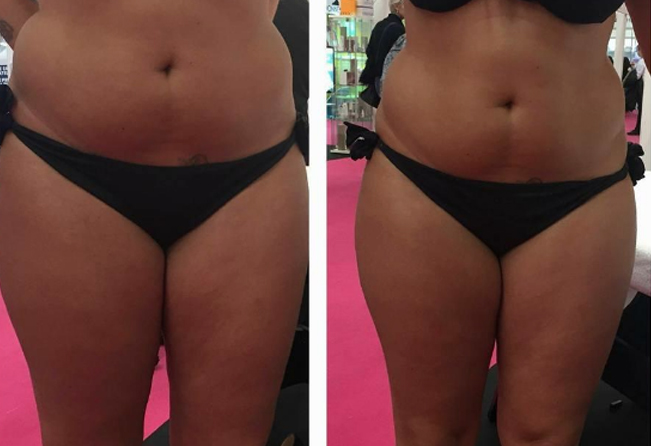 Avant et après traitement 1