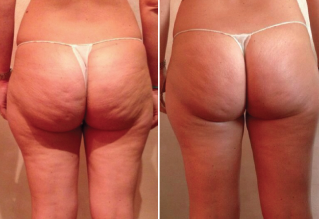 Avant et après traitement 2