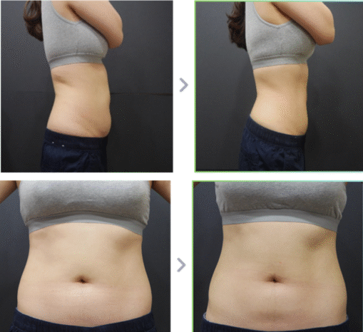 Résultat avant/après HIFU Body 2