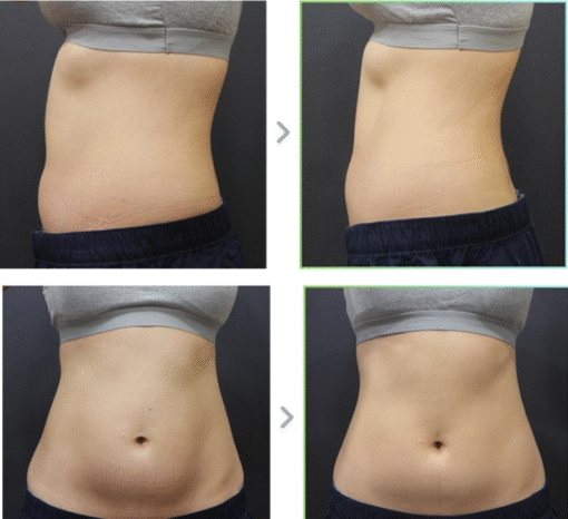 Résultat avant/après HIFU Body 1