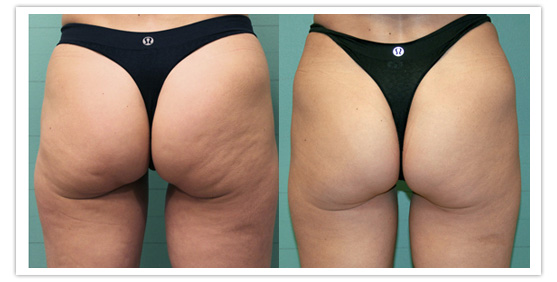 Appareil de radiofréquence pour le corps