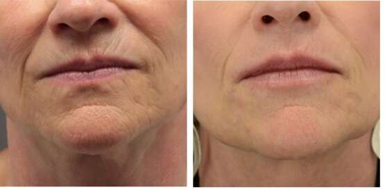 HIFU before and after chin